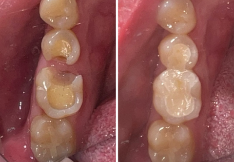 Thời gian hàn răng sâu được bao lâu